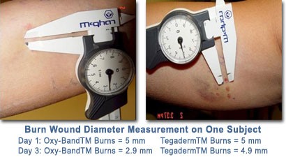 Burn Wound Diameter Measurement on One Subject